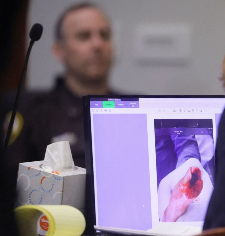 Фотодоказательства травмы, полученной во время ссоры с Эмбер Хёрд