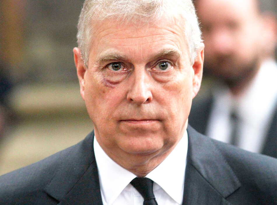 Как принц Эндрю получил синяк под глазом?