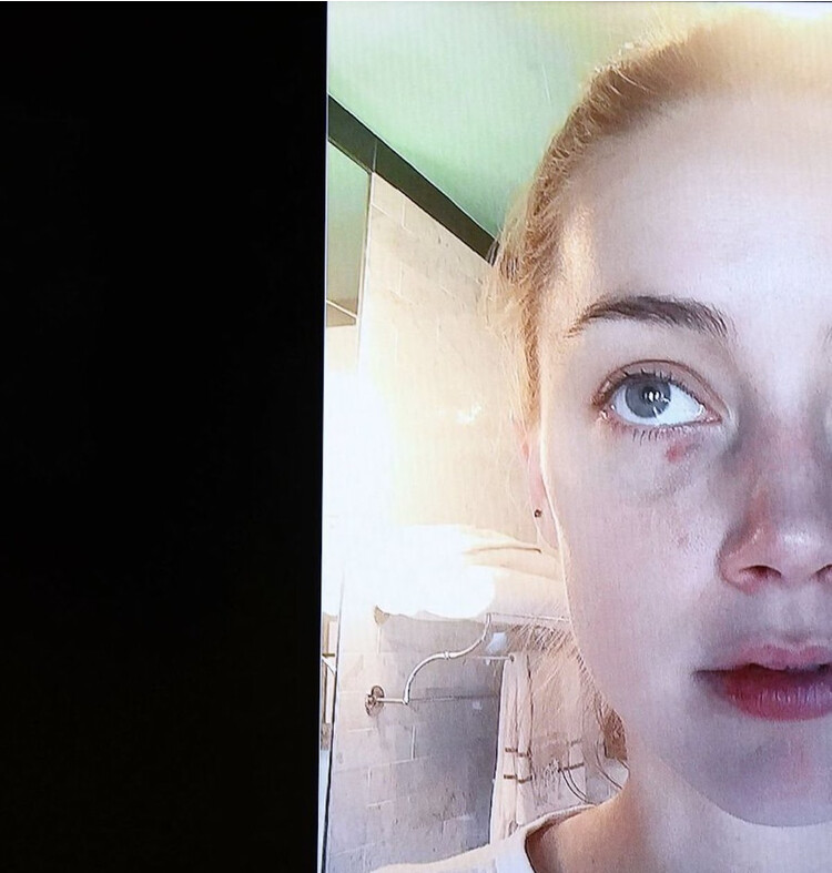 Эмбер Хёрд предоставила фотодоказательства побоев со стороны Деппа, 2022